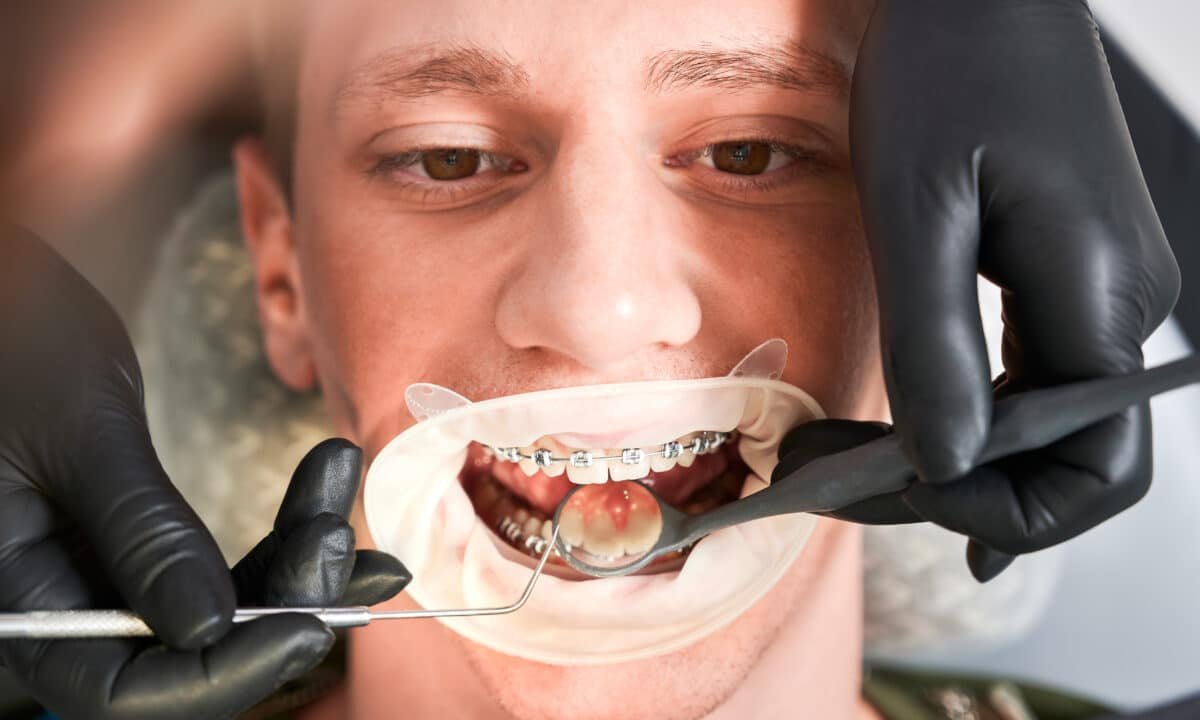 dentist-examining-man-teeth-with-dental-explorer-dental-mirror-1200x720.jpg